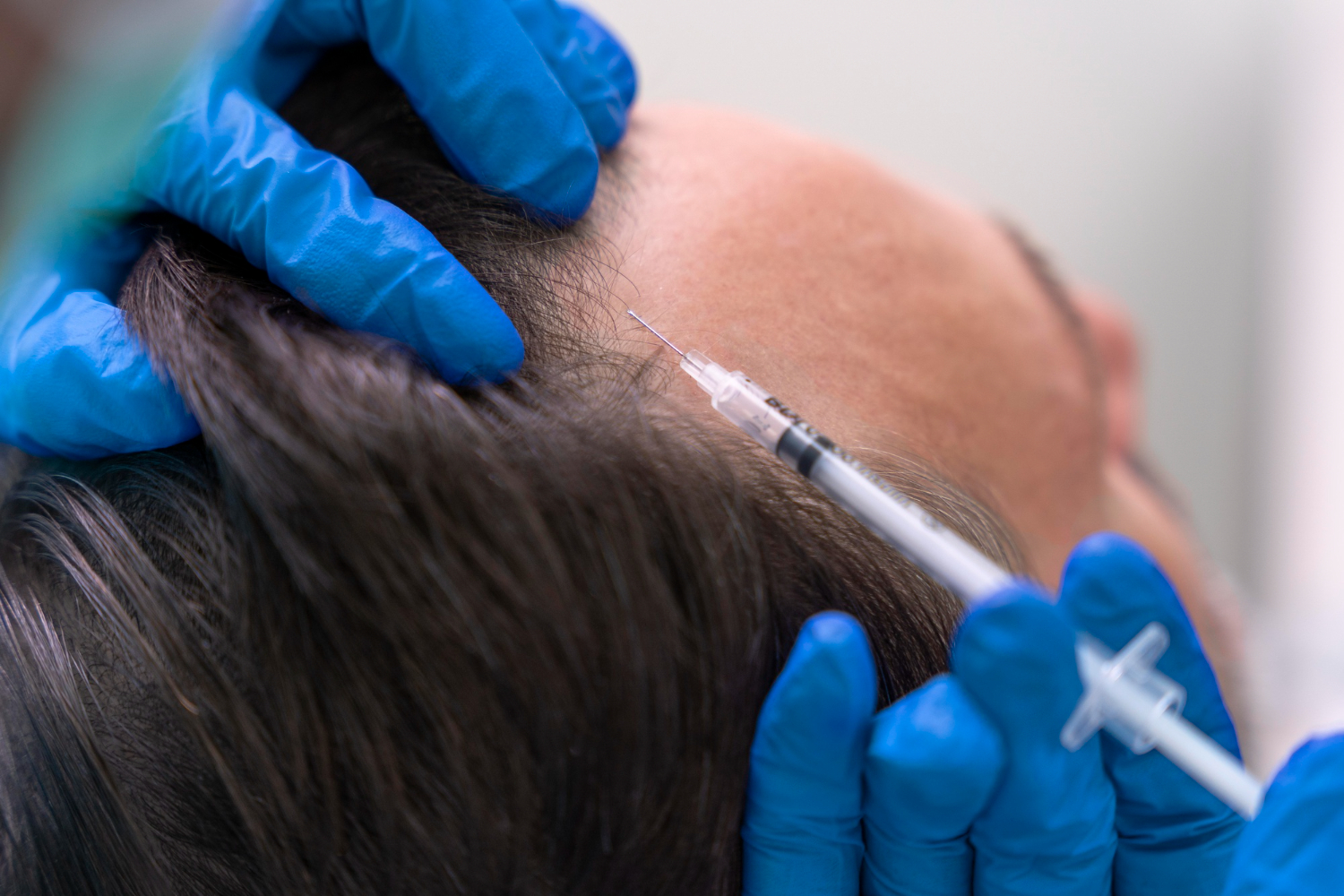 Patient receiving Minoxidil injections for hair regrowth in Riyadh