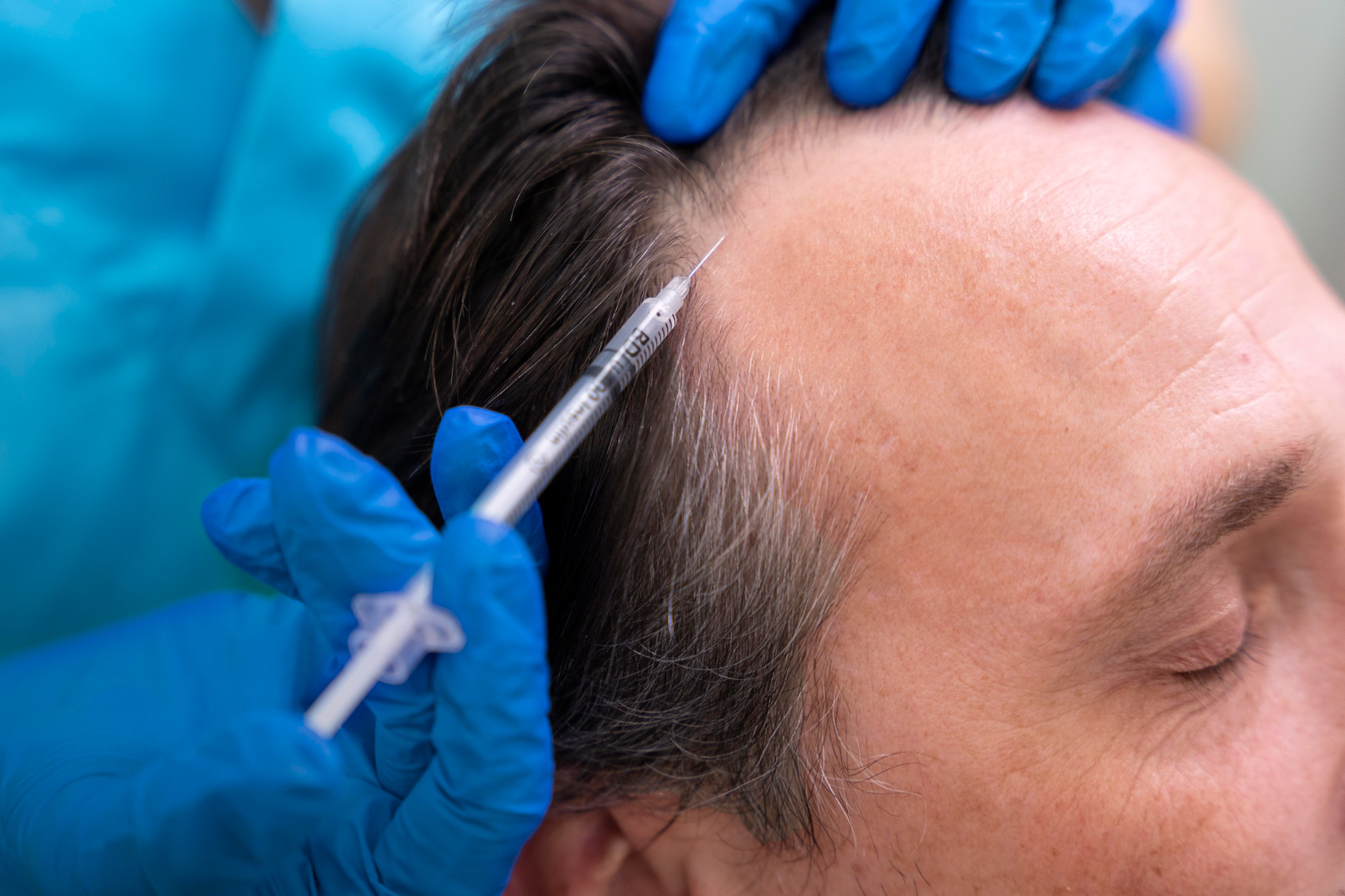 How Minoxidil Injections Work on Hair Follicles