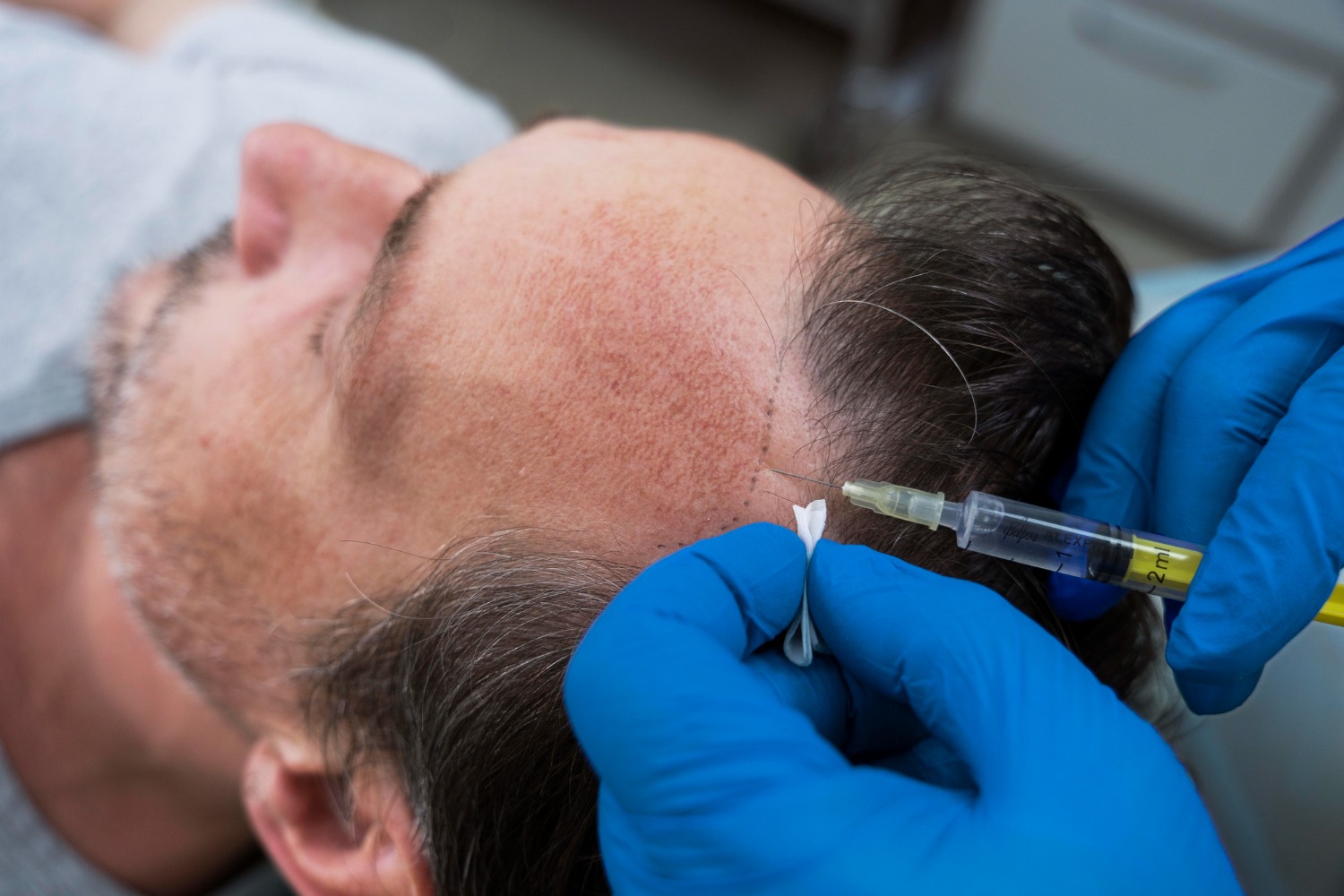 Patient Receiving PRP Treatment for Hair Regrowth at Reveal Clinics