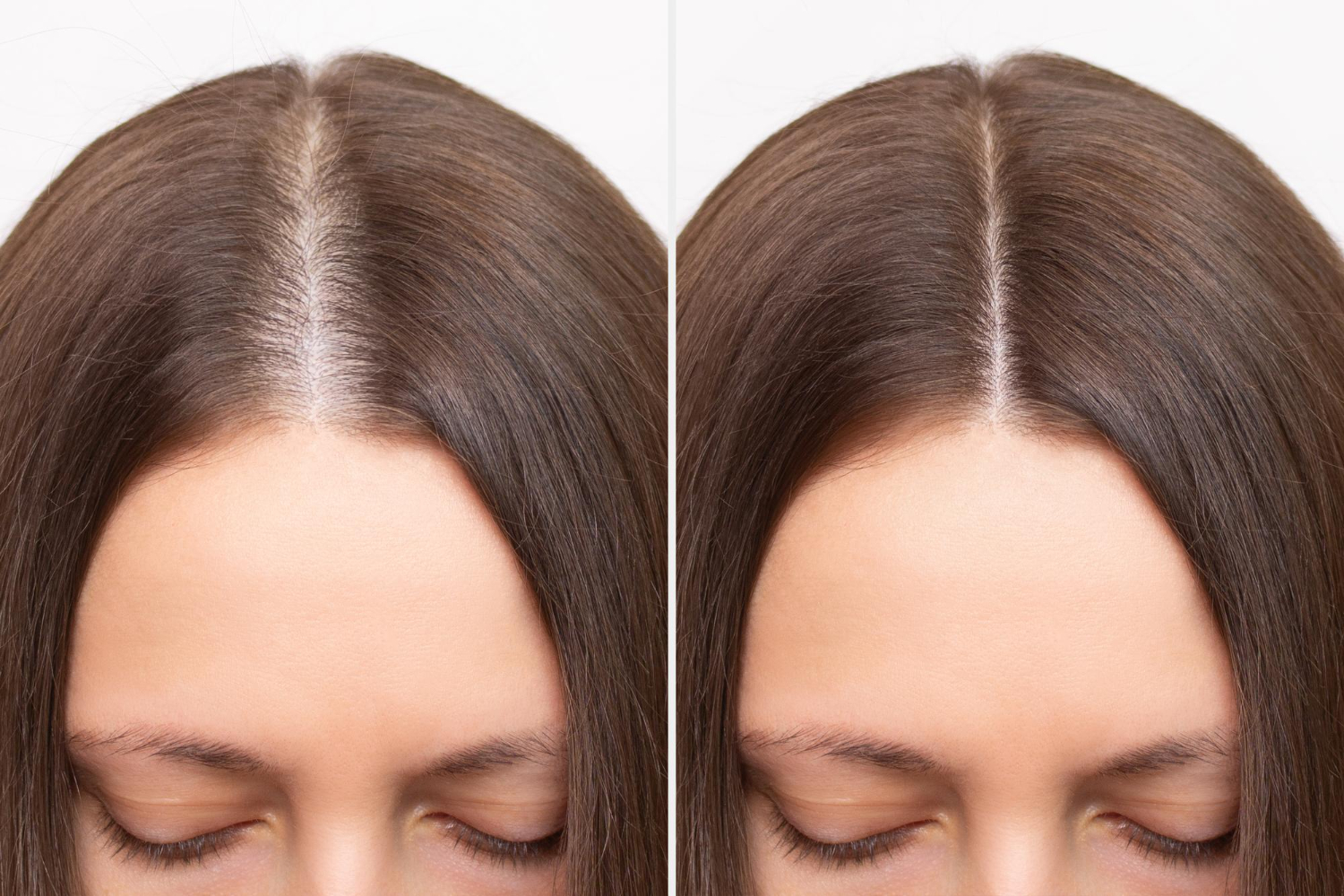 Before and after ACell Micromatrix therapy for hair loss in Riyadh