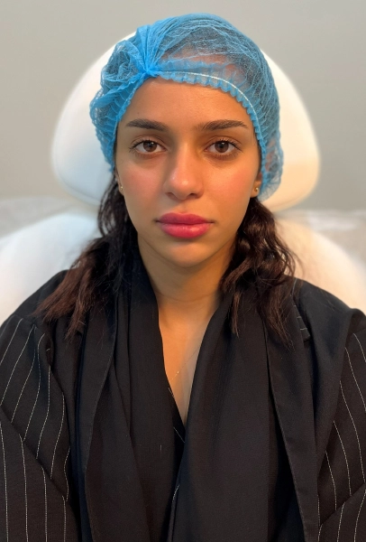 Fillers After