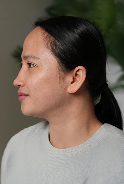 Acne Scars After