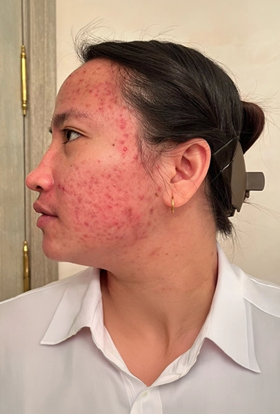 Acne Scars Before