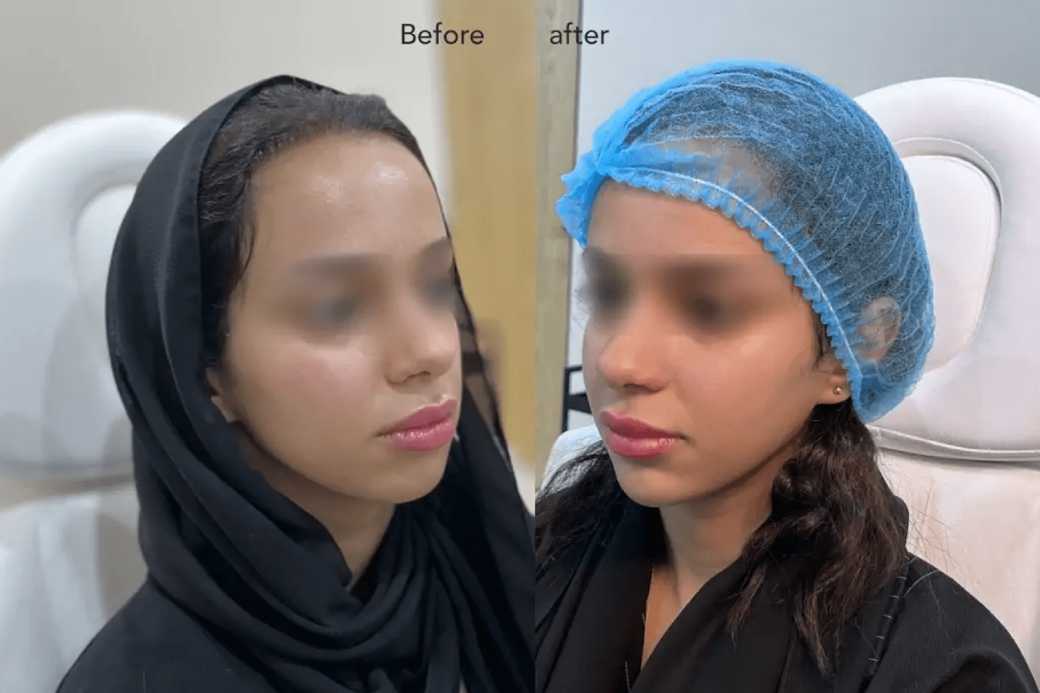 Non-Surgical-Lifting-Beofre-and-After