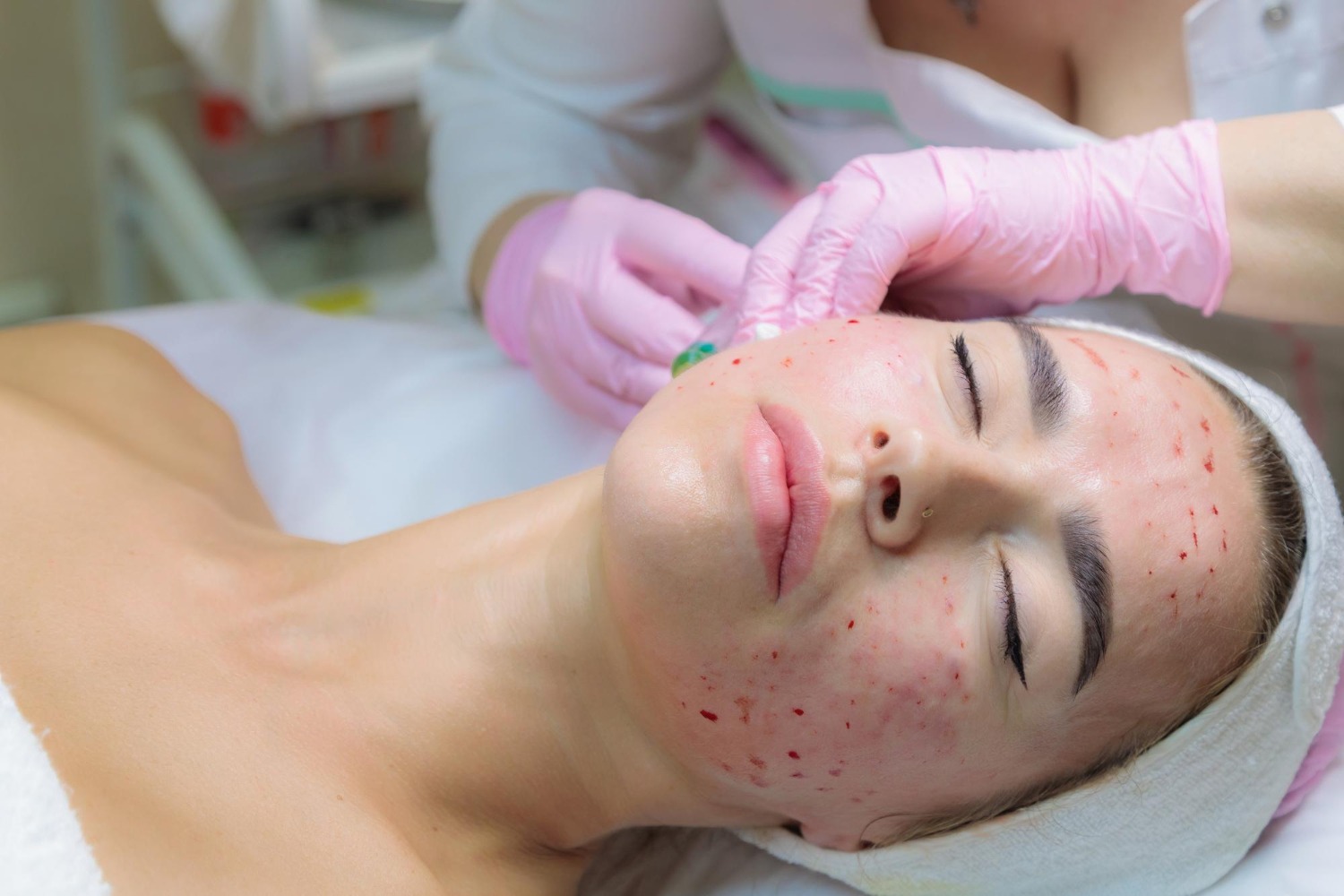 Acne scar treatment procedure at Reveal Clinics Riyadh