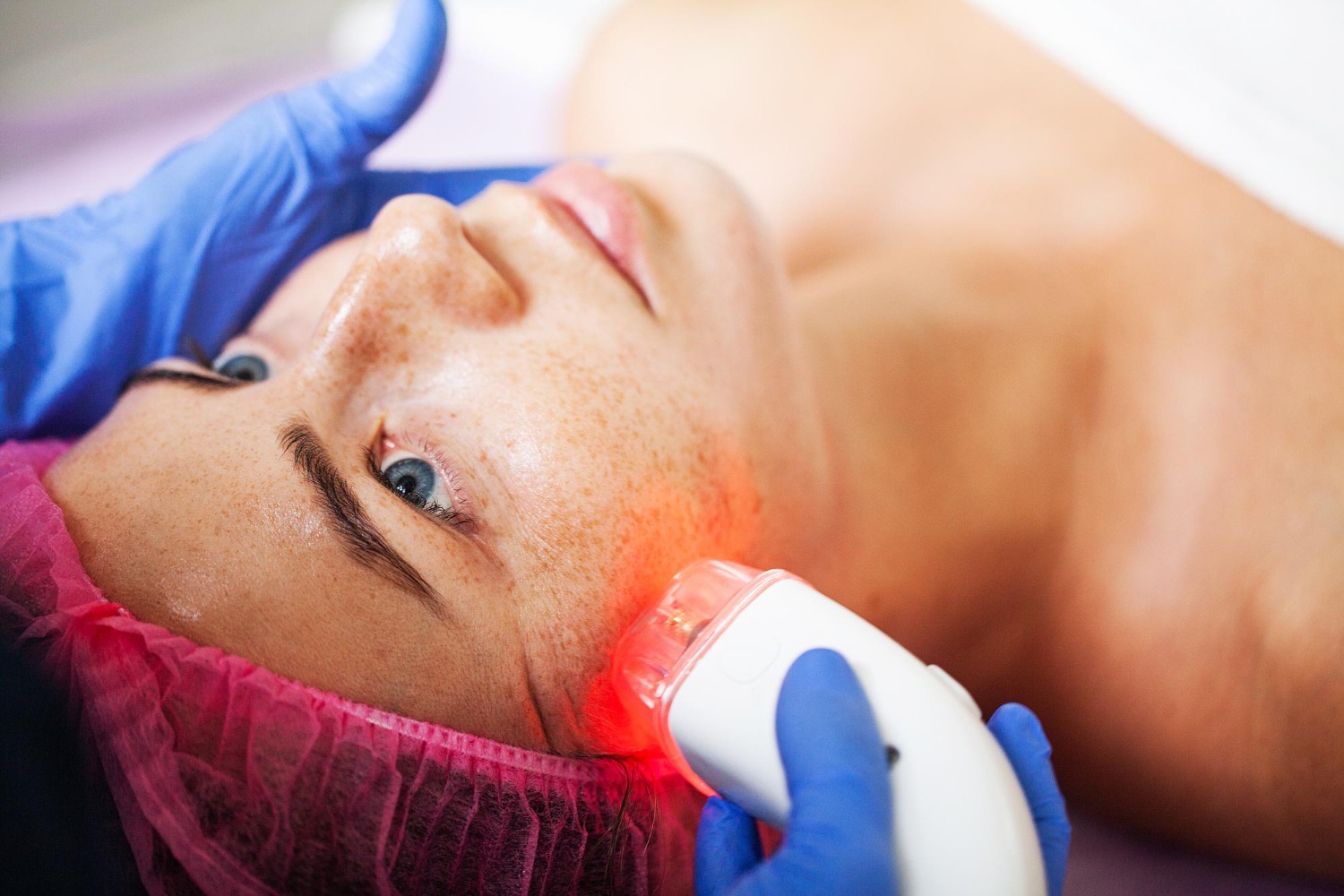 Laser treatment for facial redness at Reveal Clinics Riyadh
