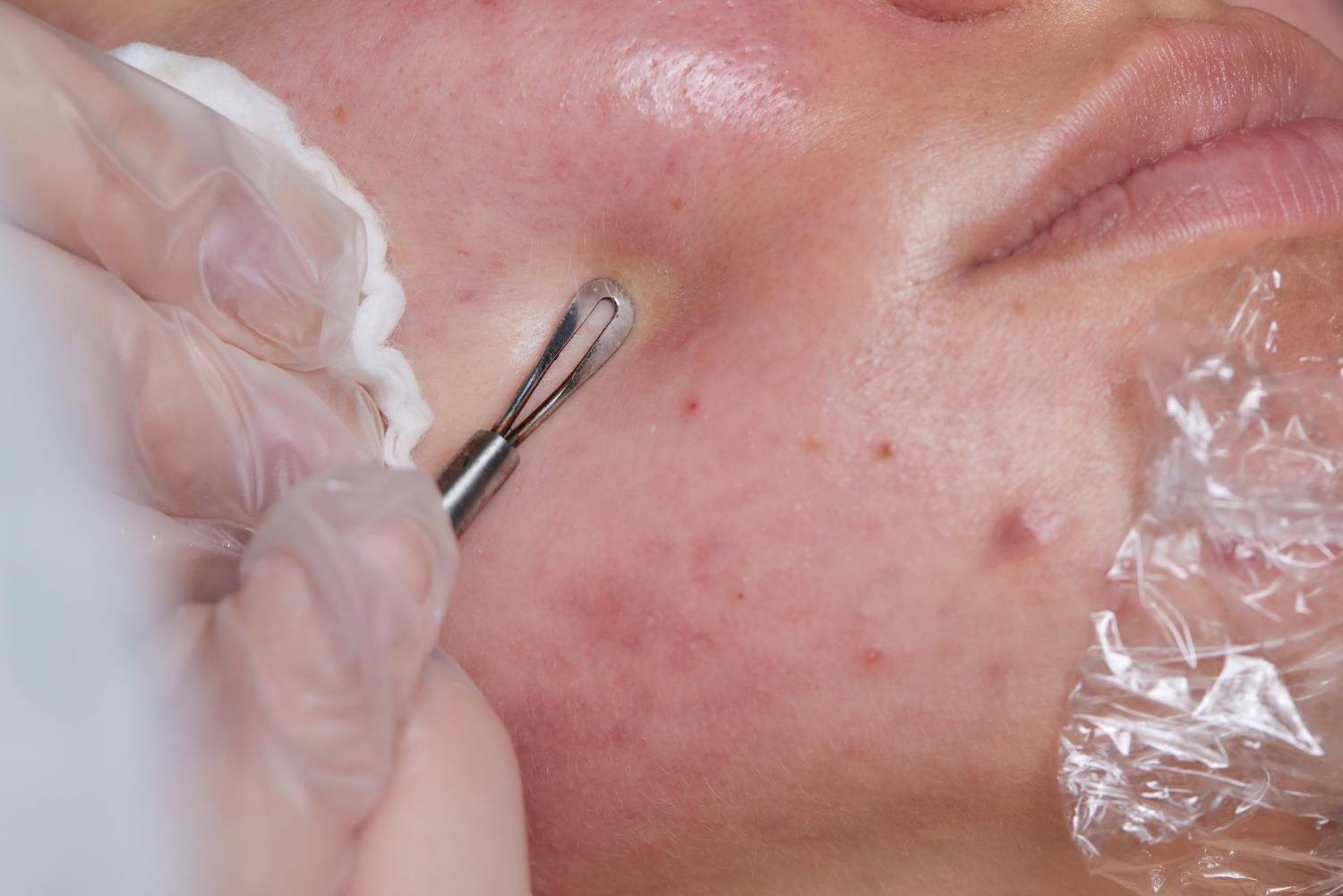 Acne scar assessment by Dr. Haitham Al-Gzlan