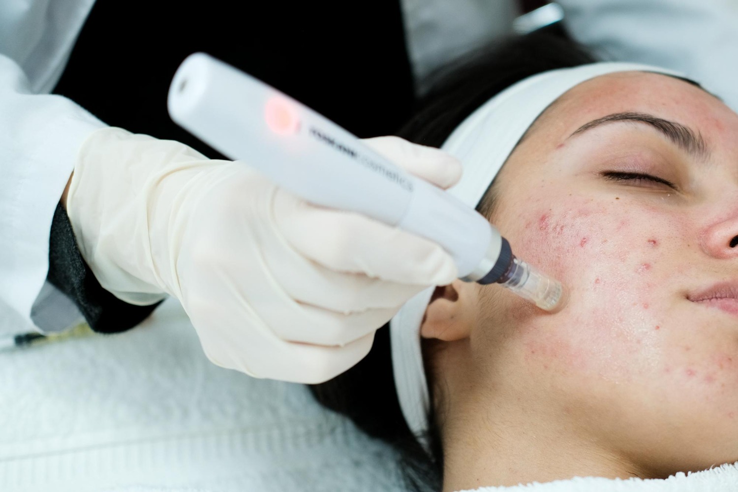 Laser dermatology treatment by Dr. Haitham Al-Gzlan