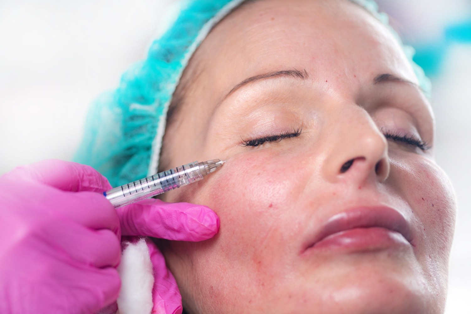 Natural under-eye filler technique by Dr. Haitham Al-Gzlan