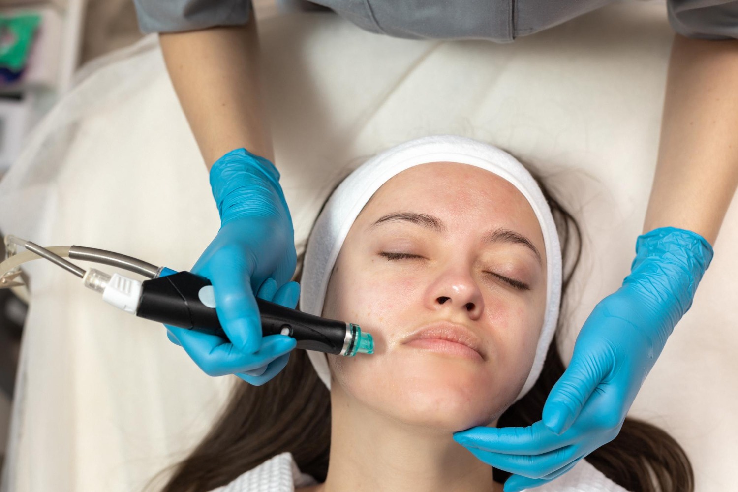 Acne scar treatment session using RF microneedling or laser in Riyadh