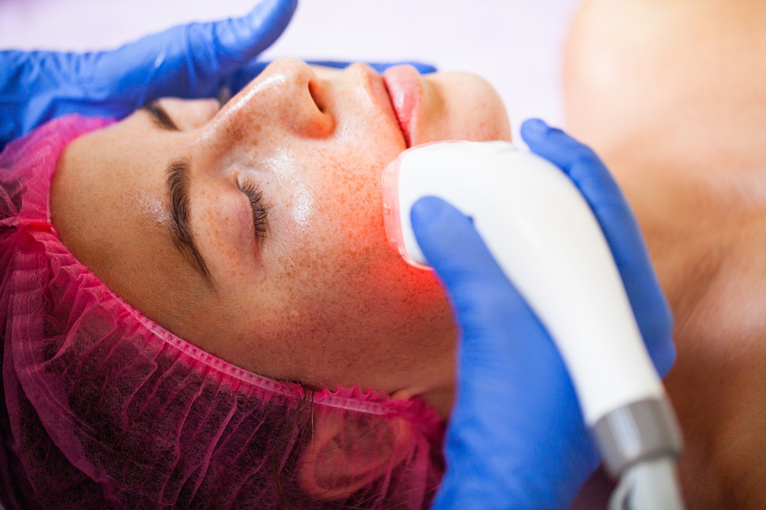 Laser and IPL skin treatment session in Riyadh