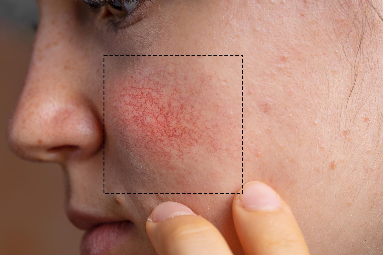 Skin redness and pigmentation assessment by dermatologist in Riyadh