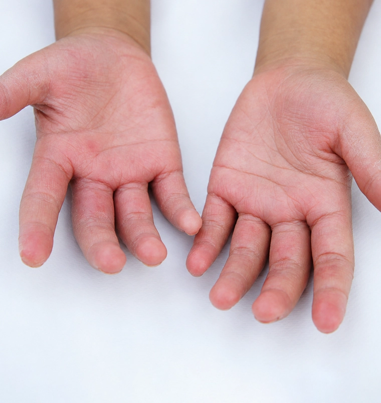 Eczema treatment result, after treatment