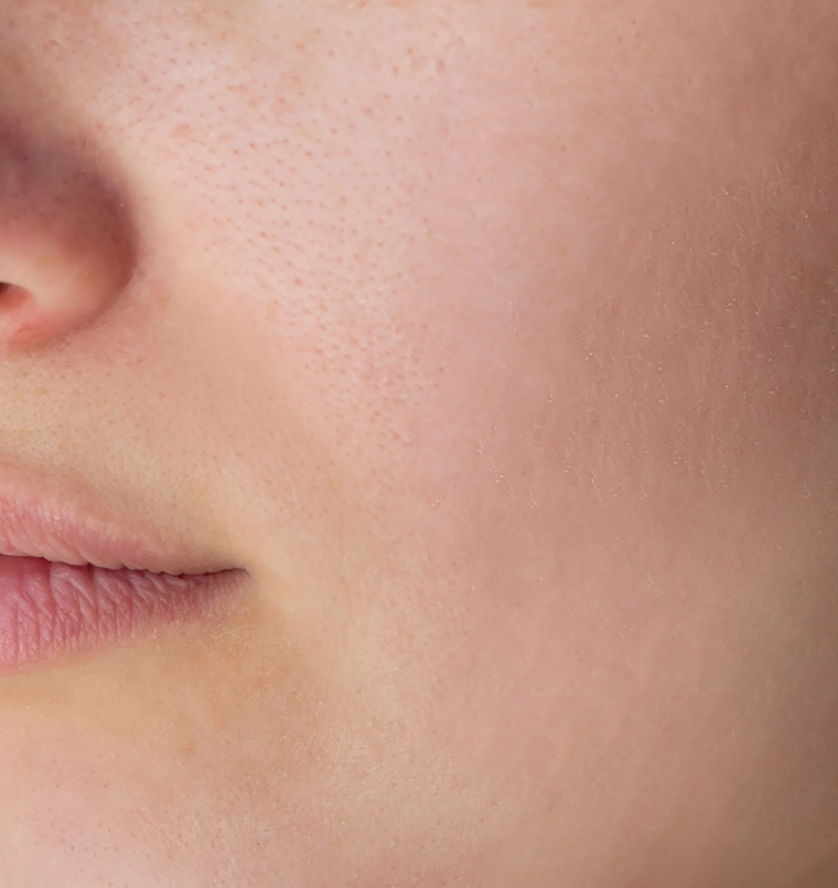 Acne scars result, after treatment