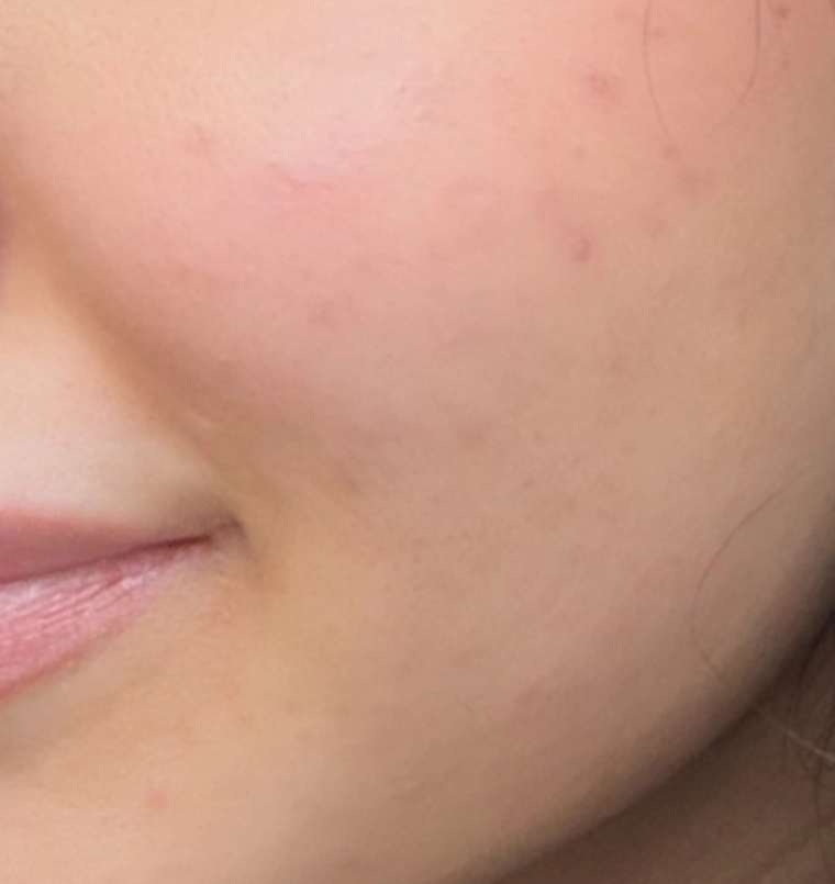 Acne scars result, after treatment