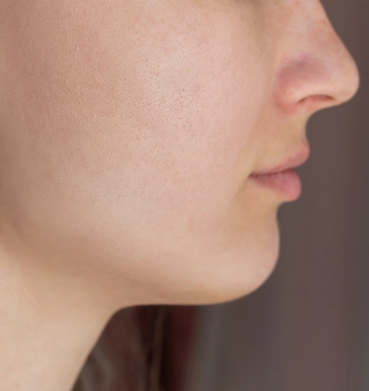 Acne scars result, after treatment