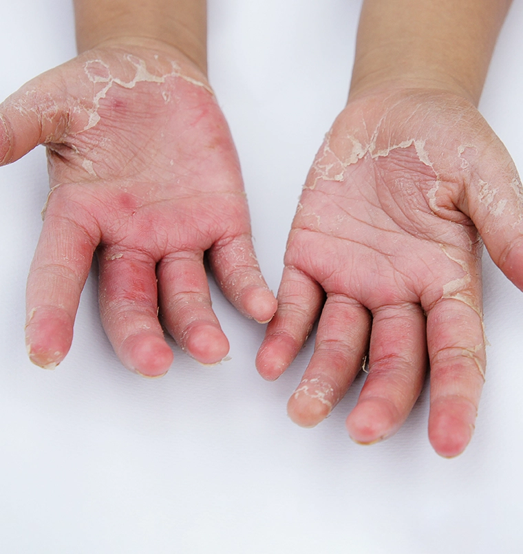 Before eczema treatment