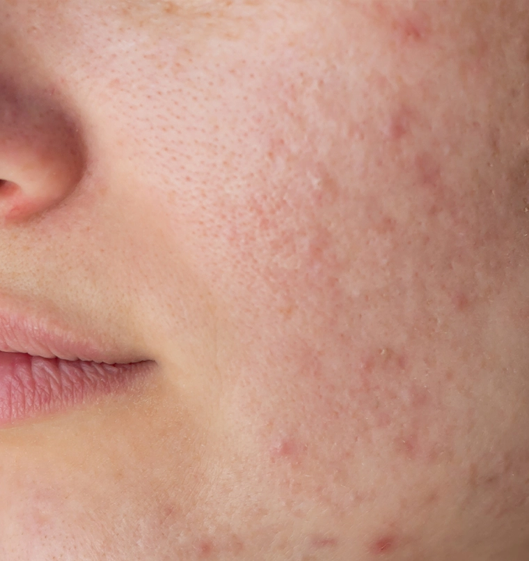 Before acne scar treatment