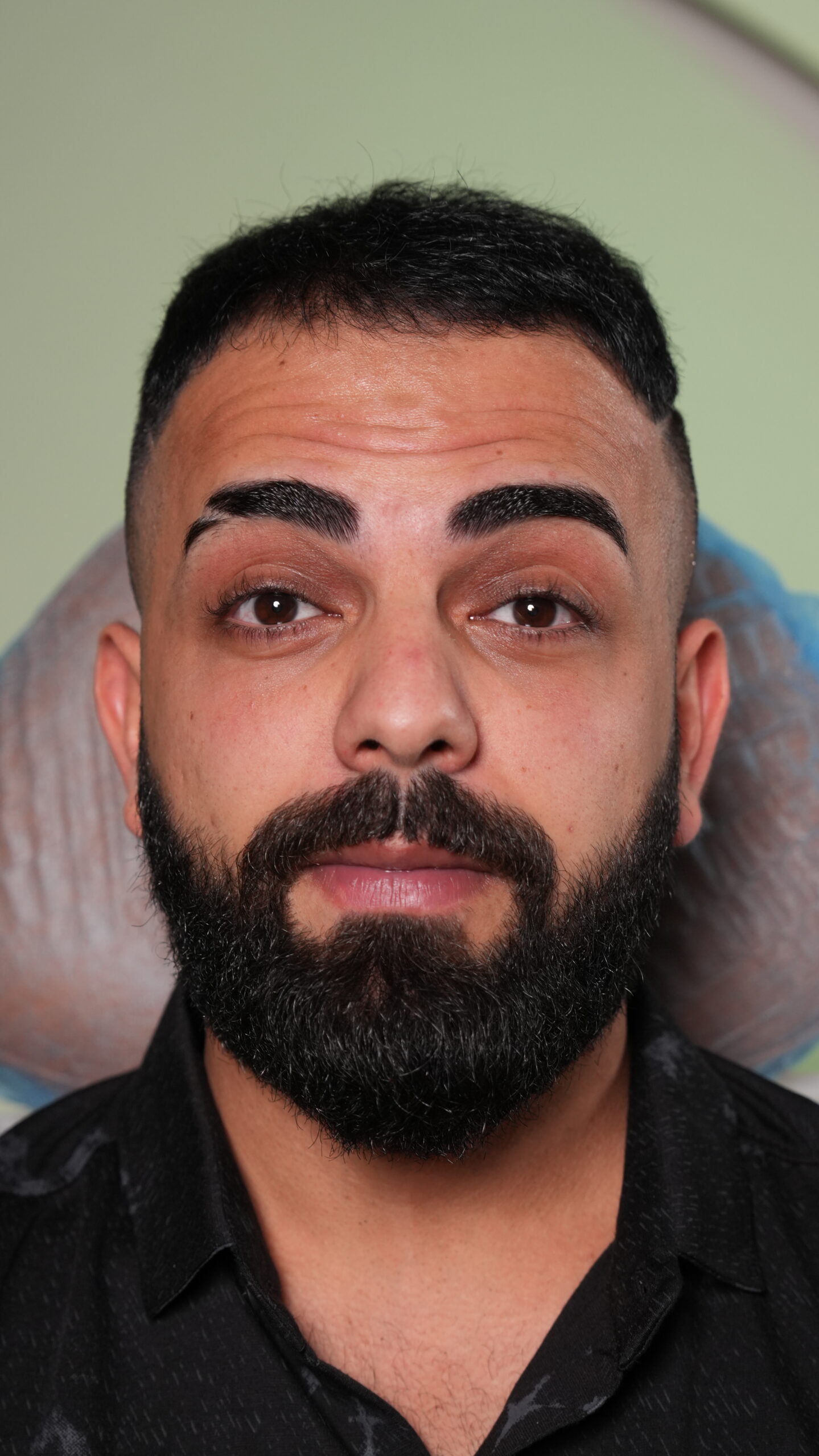 Before Botox treatment