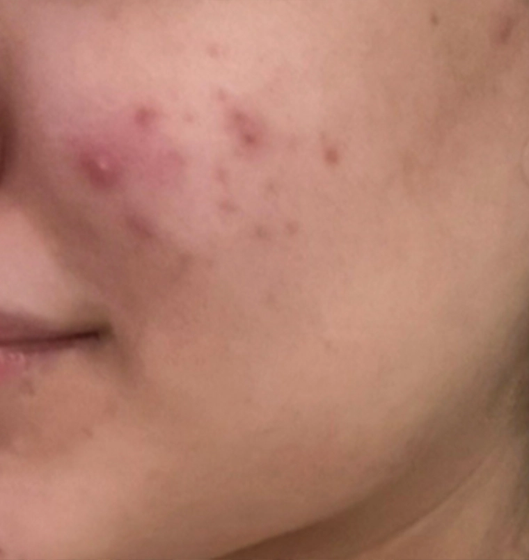 Before acne scar treatment