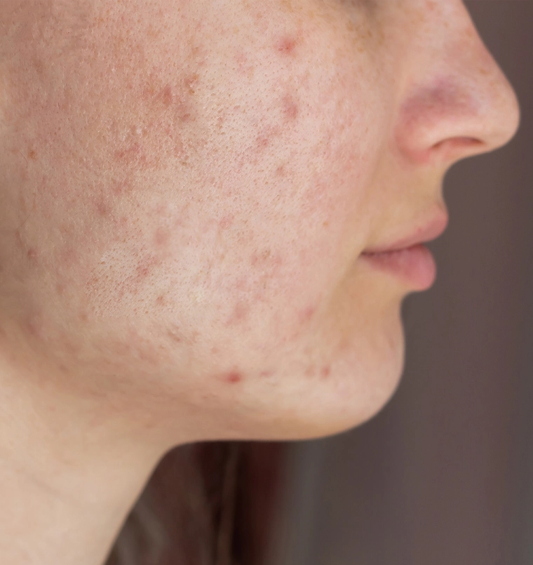Before acne scar treatment