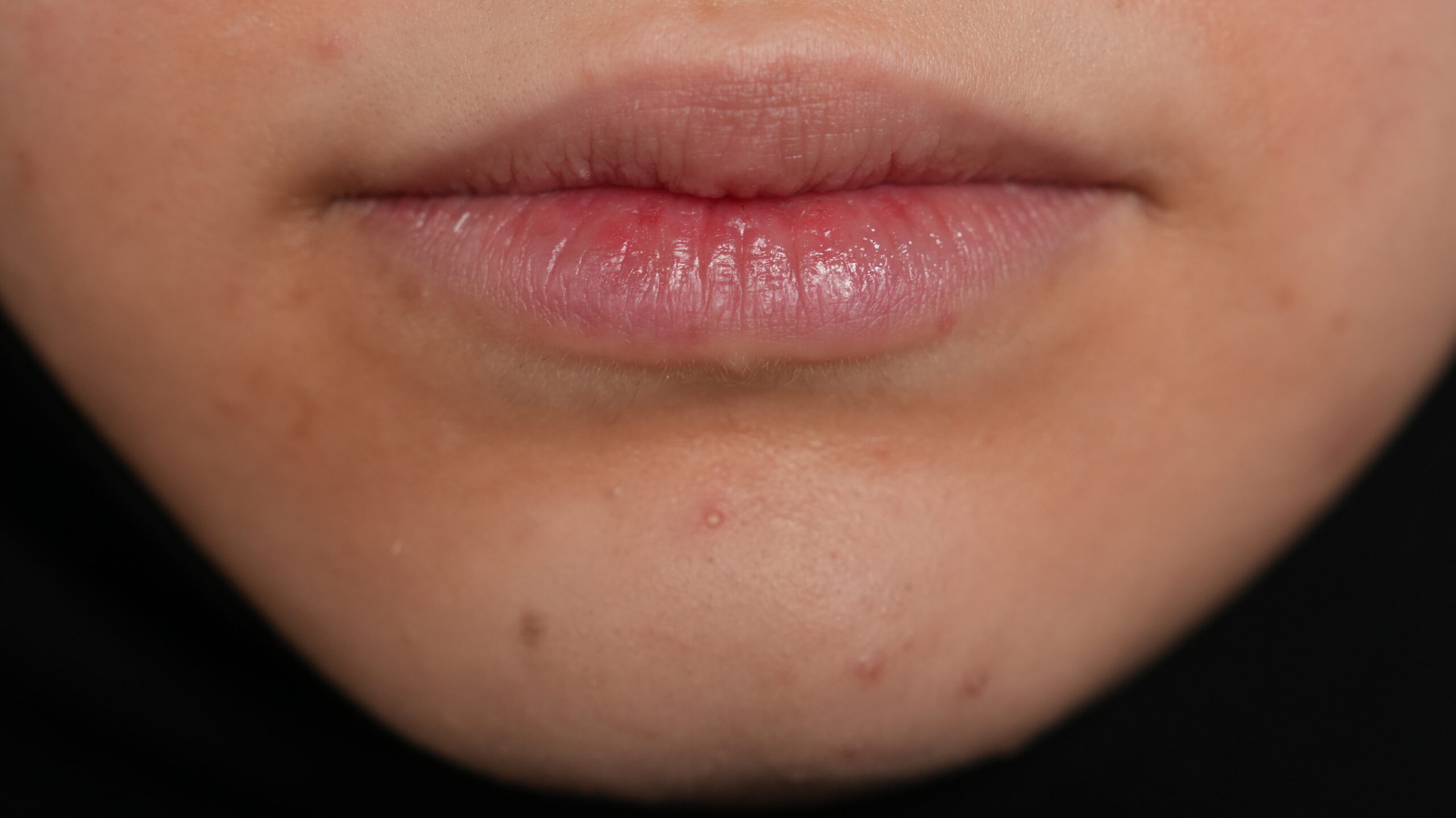 Before dermal filler treatment