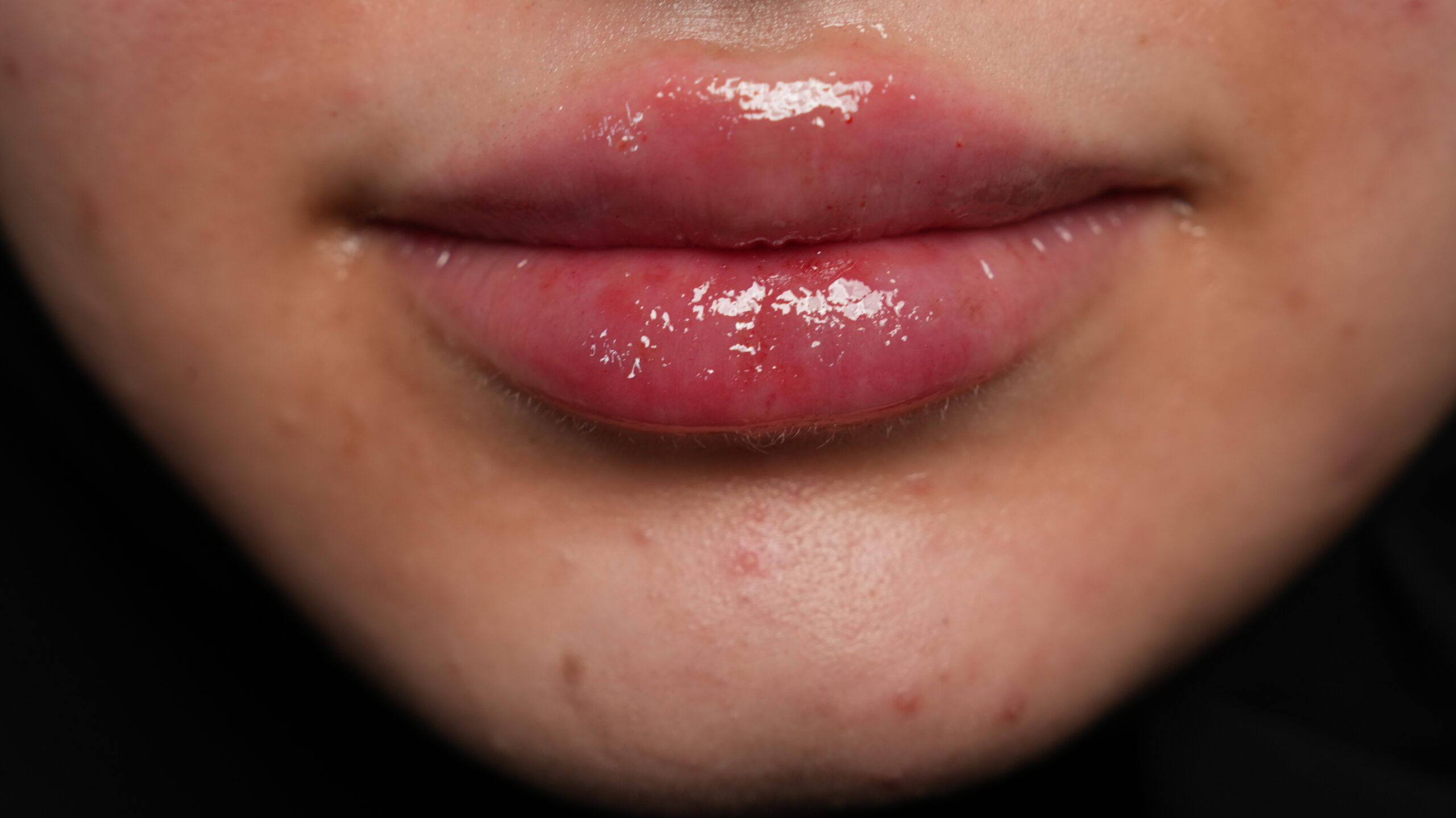 Dermal filler result, after treatment