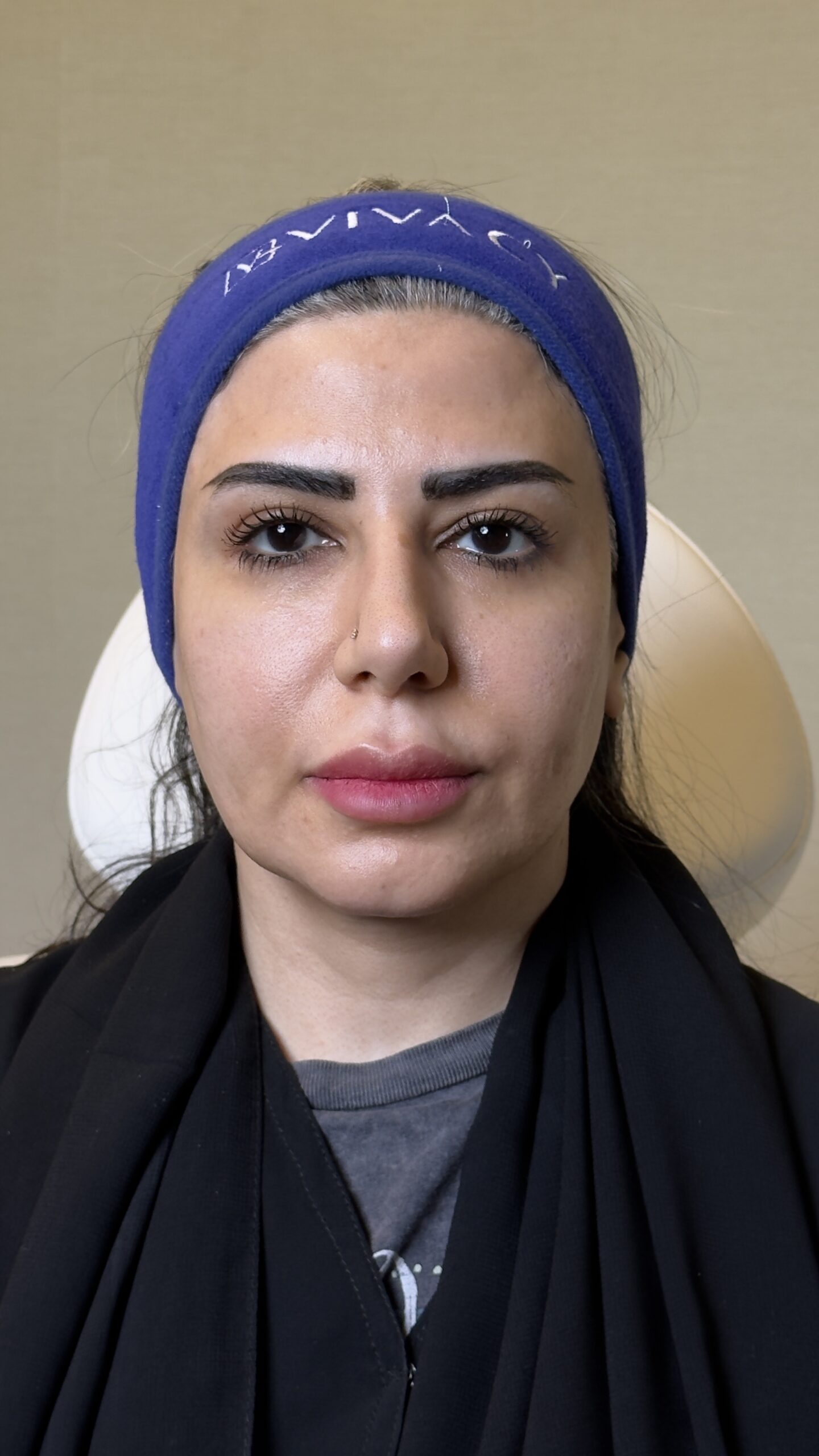 Before dermal filler treatment