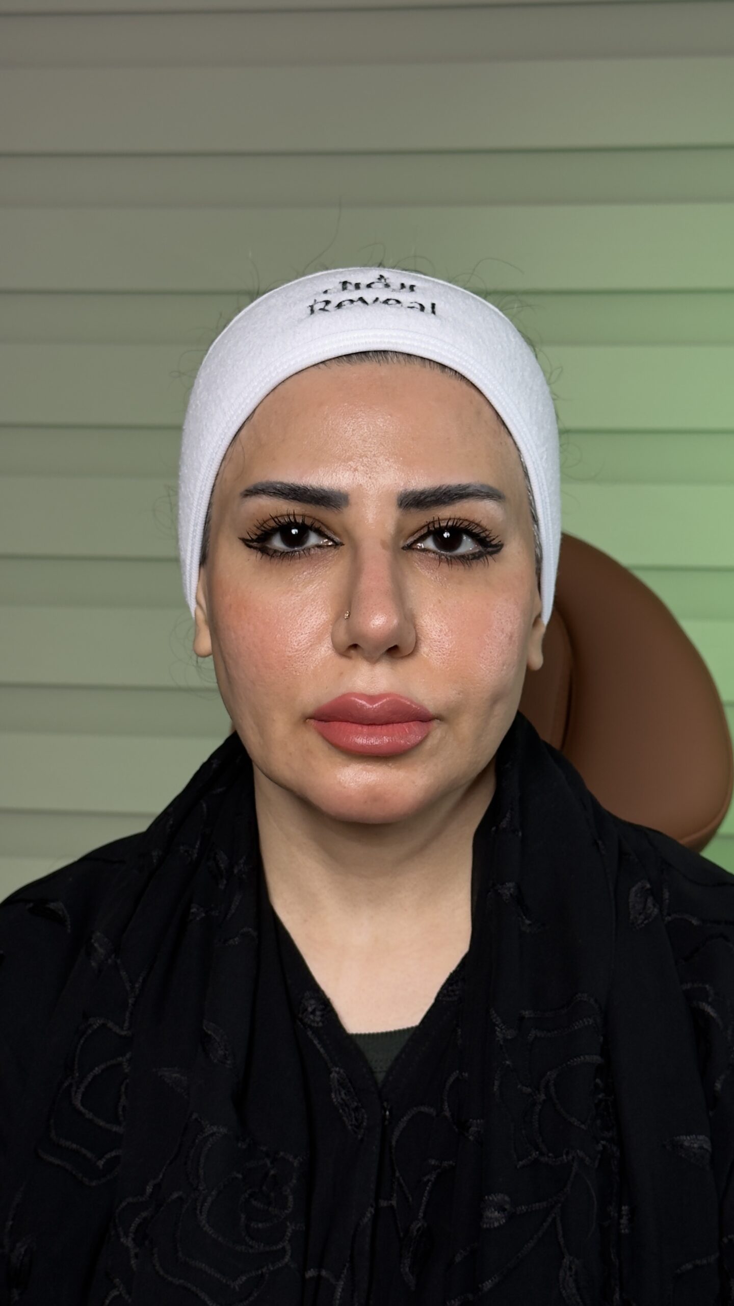 Dermal filler result, after treatment