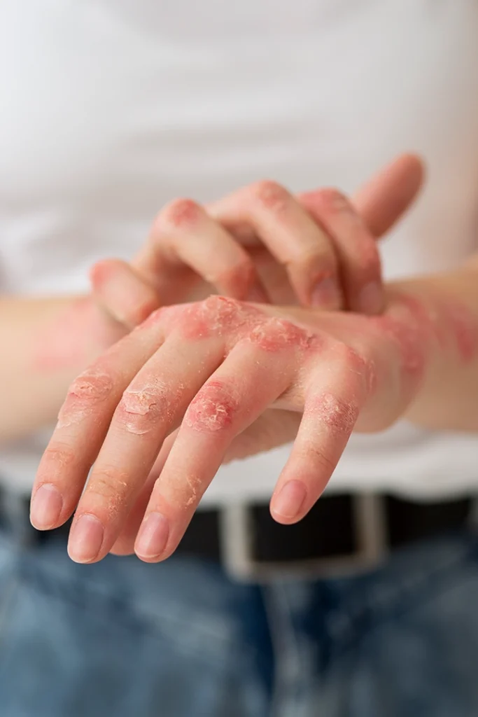 Topical skincare treatment for eczema and dry sensitive skin