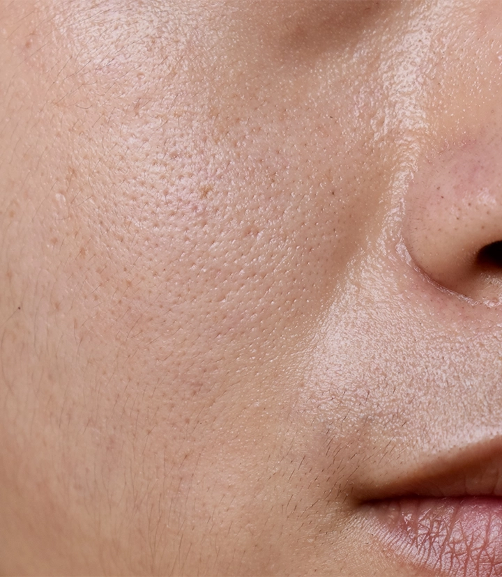 Pores treatment options for enlarged pores and uneven skin texture