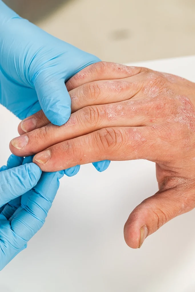 Biologic therapy injections and IV infusions for psoriasis