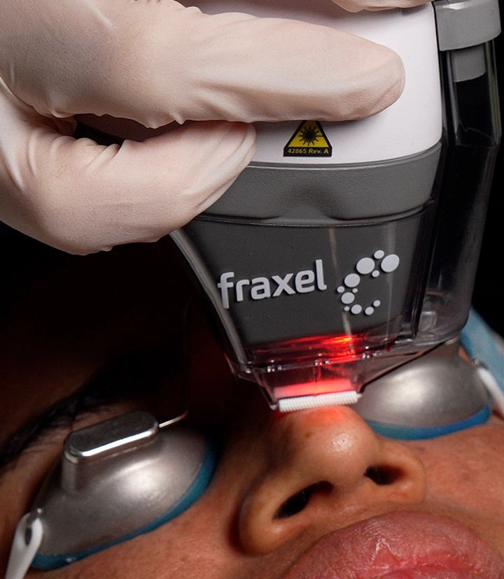 Fraxel laser treatment for skin texture, pigmentation and acne scars