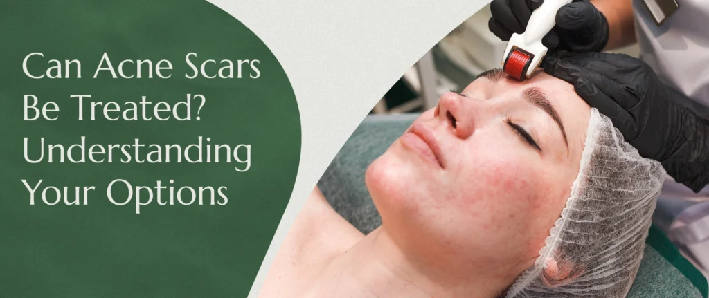 Can acne scars be treated - understanding your options