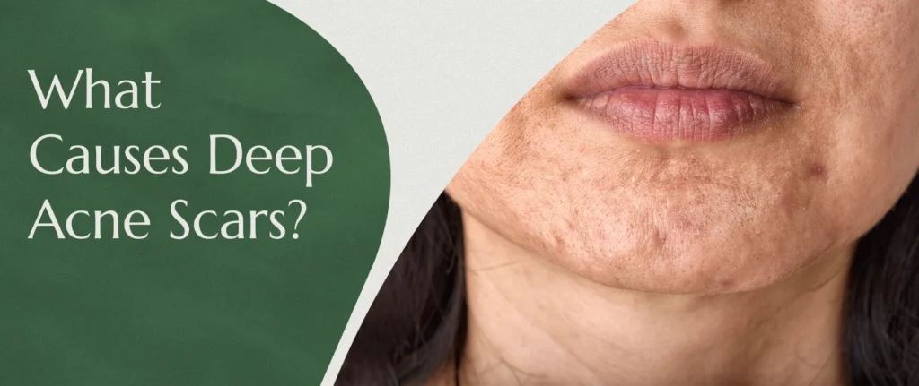 What causes deep acne scars - ice pick, boxcar and rolling scars