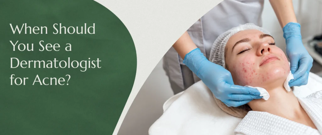 When Should You See a Dermatologist for Acne?
