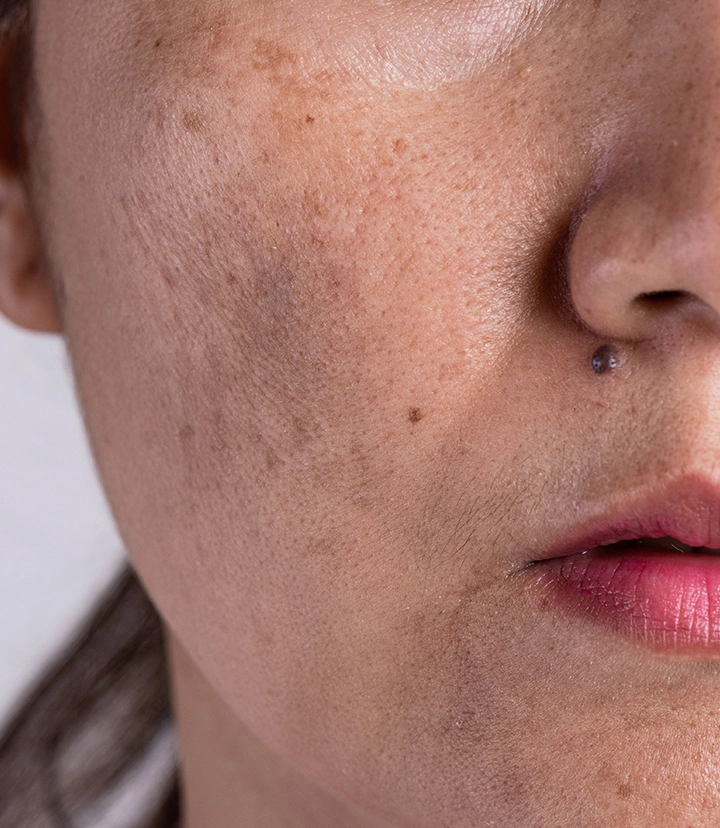 Hyperpigmentation treatment options for melasma, dark spots and uneven skin tone