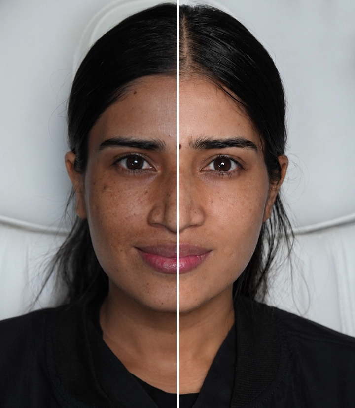 Facial melasma pigmentation and uneven skin tone